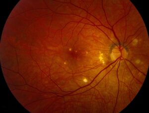 Clinical eye photograph illustrating Pneumocystis Choroidopathy Advanced Hiv