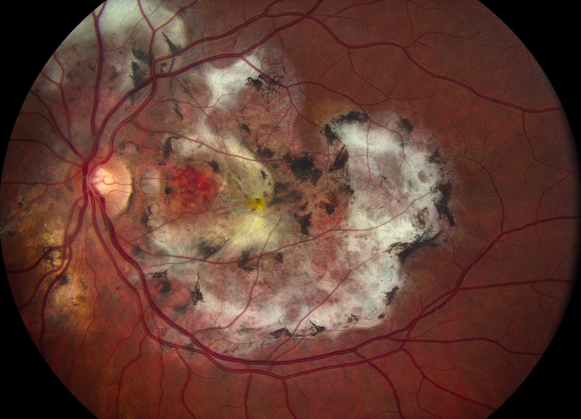 Clinical eye photograph illustrating Pneumocystis Choroidopathy Advanced Hiv