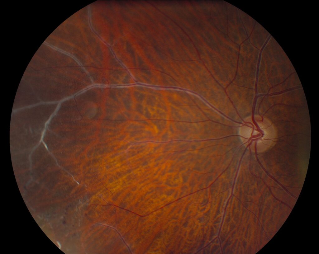 Clinical image illustrating Polyarteritis Nodosa