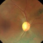 Clinical eye photograph illustrating Post Ebola Uveitis