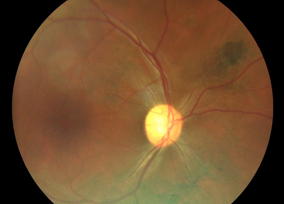 Clinical eye photograph illustrating Post Ebola Uveitis