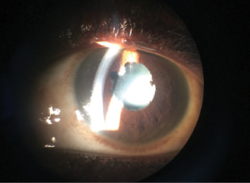 Clinical eye photograph illustrating Post Ebola Uveitis