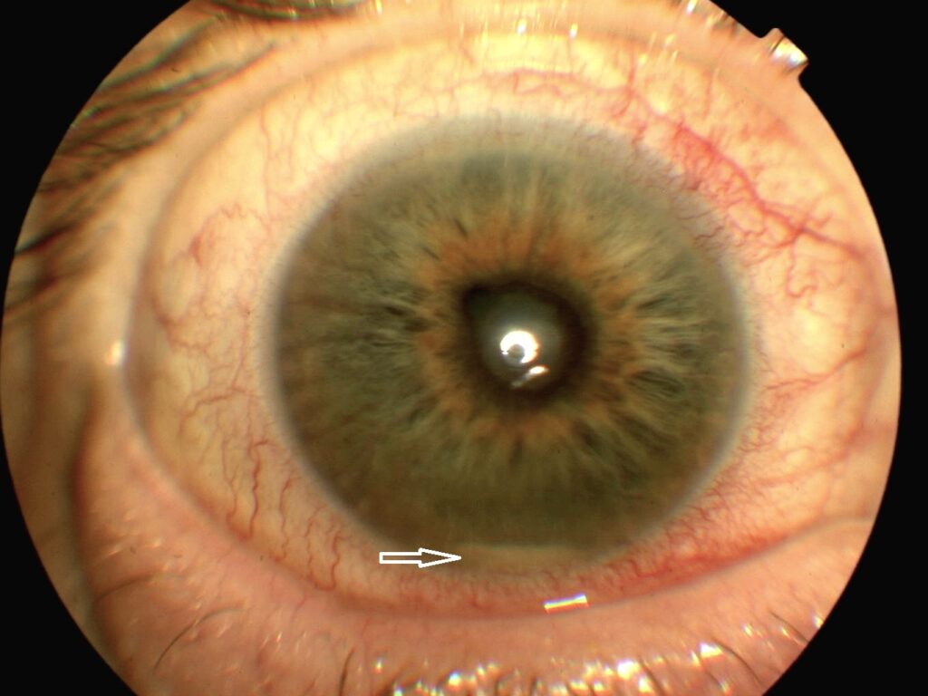 Clinical eye photograph illustrating Post Injection Endophthalmitis