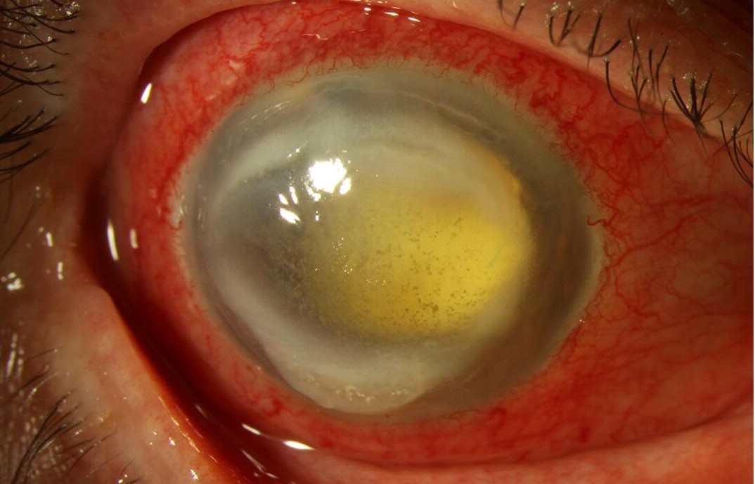 Clinical eye photograph illustrating Post Injection Endophthalmitis