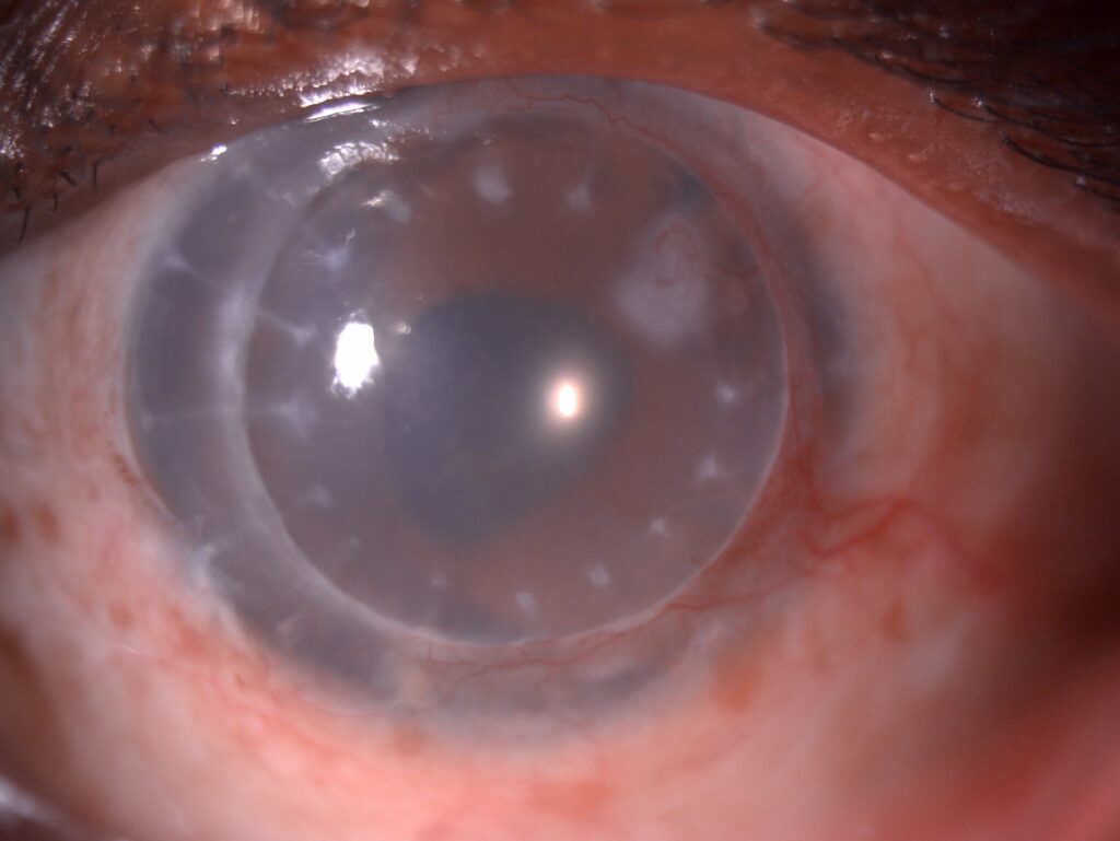 Post-Keratoplasty Astigmatism: Causes and Correction