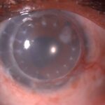 Clinical eye photograph illustrating Post Keratoplasty Astigmatism