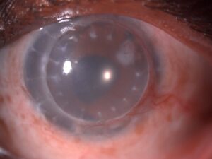 Clinical eye photograph illustrating Post Keratoplasty Astigmatism