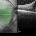 Clinical eye photograph illustrating Post Vaccination Uveitis Case Review