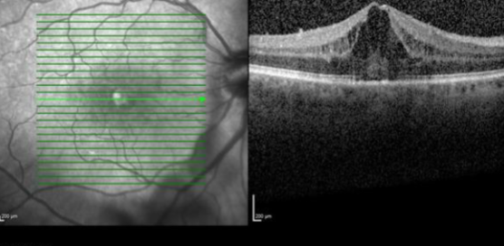 Uveitis After Vaccination: What the Reported Cases Show