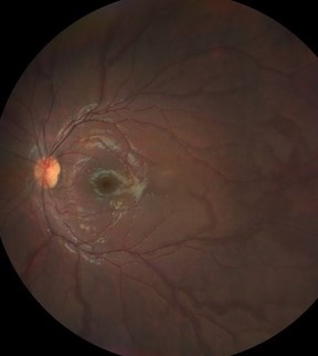 Clinical eye photograph illustrating Post Vaccination Uveitis Case Review