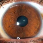 Clinical eye photograph illustrating Posterior Embryotoxon Clinical Significance
