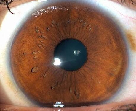 Posterior Embryotoxon: A Prominent Ring That’s Usually Just an Anatomic Variant