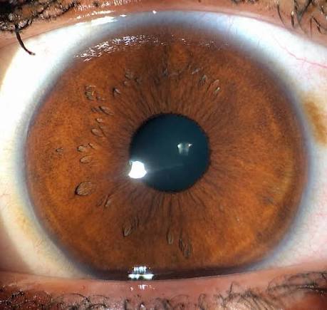 Posterior Embryotoxon: A Prominent Ring That’s Usually Just an Anatomic Variant