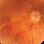 Clinical eye photograph illustrating Posterior Staphyloma Overview