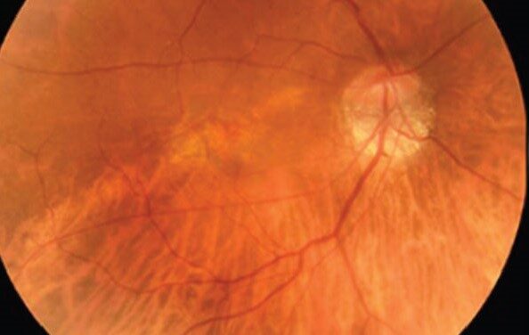 Posterior Staphyloma: What the Bulging Sclera Means for a Myopic Eye