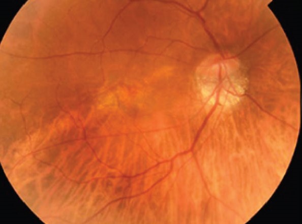 Posterior Staphyloma: What the Bulging Sclera Means for a Myopic Eye