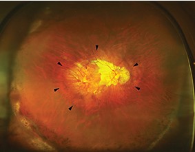 Clinical eye photograph illustrating Posterior Staphyloma Overview