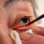 Clinical image illustrating Povidone-Iodine Before Intravitreal Injection