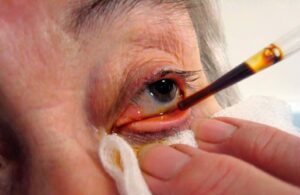 Clinical image illustrating Povidone-Iodine Before Intravitreal Injection