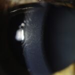 Clinical eye photograph illustrating Pre Descemet Corneal Dystrophy