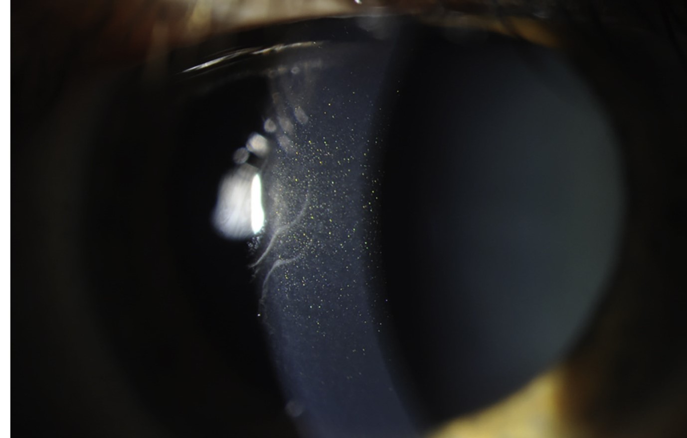 Clinical eye photograph illustrating Pre Descemet Corneal Dystrophy