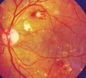 Clinical eye photograph illustrating Preoperative Anti Vegf Diabetic Vitrectomy