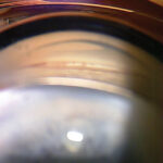 Clinical eye photograph illustrating Primary Angle Closure Suspect