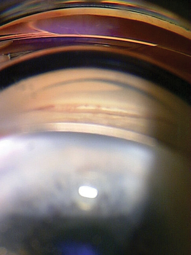 Clinical eye photograph illustrating Primary Angle Closure Suspect