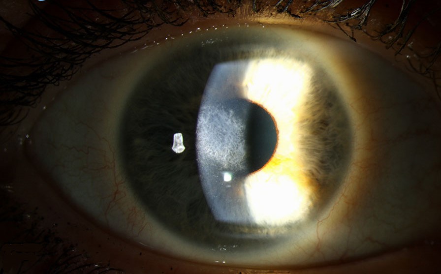 Clinical eye photograph illustrating Prk Corneal Haze