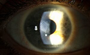 Clinical eye photograph illustrating Prk Photorefractive Keratectomy
