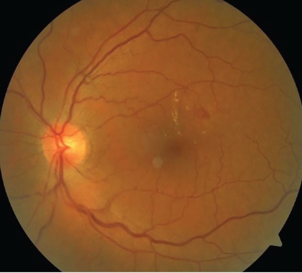 Protocol V: Observing Good-Vision Diabetic Macular Edema