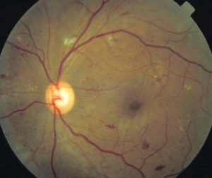 Clinical eye photograph illustrating Protocol W Panorama Anti Vegf Nonproliferative Diabetic Retinopathy