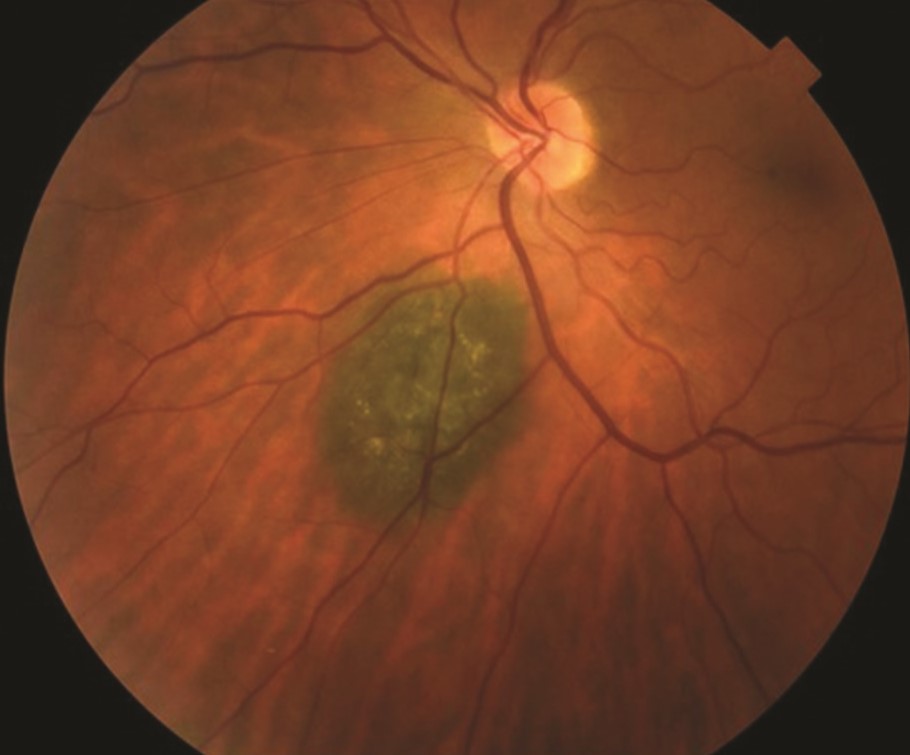 Clinical eye photograph illustrating Proton Beam Therapy Uveal Melanoma