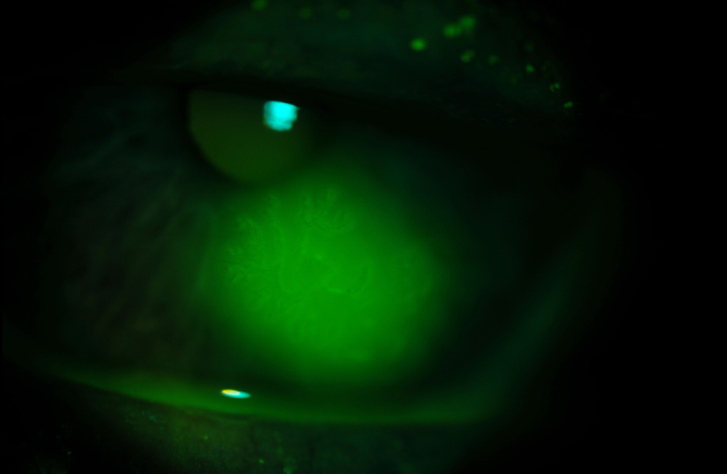 Clinical image illustrating Pseudodendrite (Zoster Lesion)
