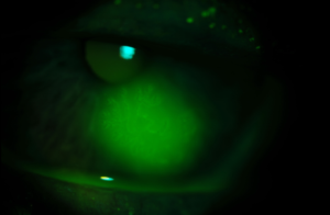 Clinical image illustrating Pseudodendrite (Zoster Lesion)