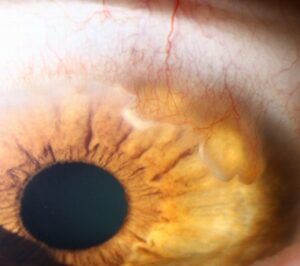Clinical image illustrating Pseudohypopyon (False Hypopyon)