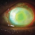 Clinical eye photograph illustrating Pseudomonas Keratitis