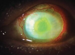 Clinical eye photograph illustrating Pseudomonas Keratitis