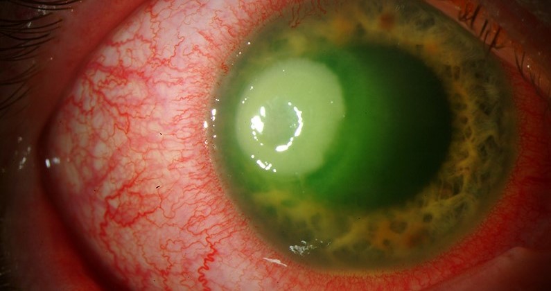 Clinical eye photograph illustrating Pseudomonas Keratitis
