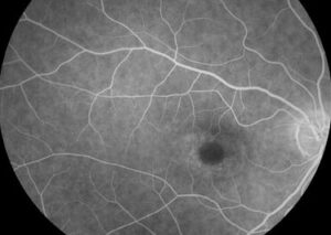 Clinical image illustrating Pseudoptosis (False Droopy Eyelid) (figure 1)