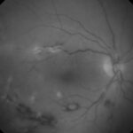 Clinical eye photograph illustrating Psoriatic Arthritis Uveitis