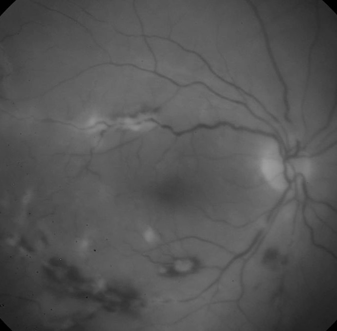 Clinical eye photograph illustrating Psoriatic Arthritis Uveitis