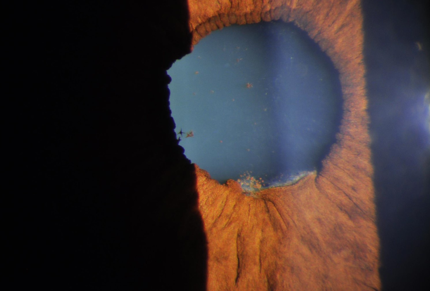 Clinical eye photograph illustrating Psoriatic Arthritis Uveitis