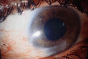 Clinical eye photograph illustrating Pterygium Recurrence