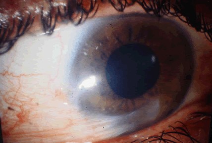 Clinical eye photograph illustrating Pterygium Recurrence
