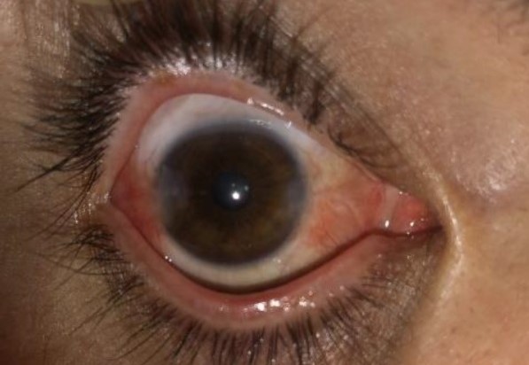 Clinical eye photograph illustrating Pterygium Recurrence