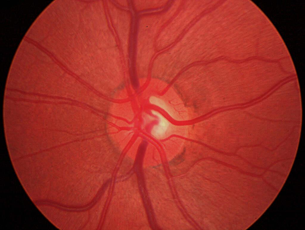 Clinical eye photograph illustrating Pulfrich Phenomenon Optic Nerve Delay