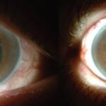 Clinical eye photograph illustrating Pupillary Capture Iol