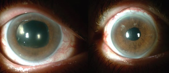 Pupillary Capture of the Intraocular Lens: When the Pupil Slips Over the Optic