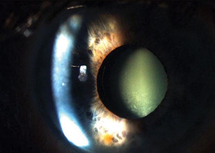 Clinical eye photograph illustrating Pupillary Capture Iol